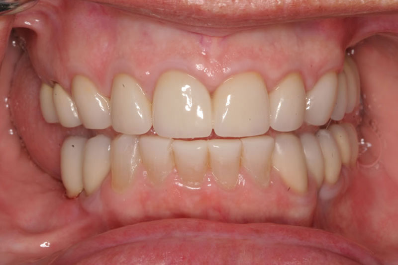 veneers case2 after