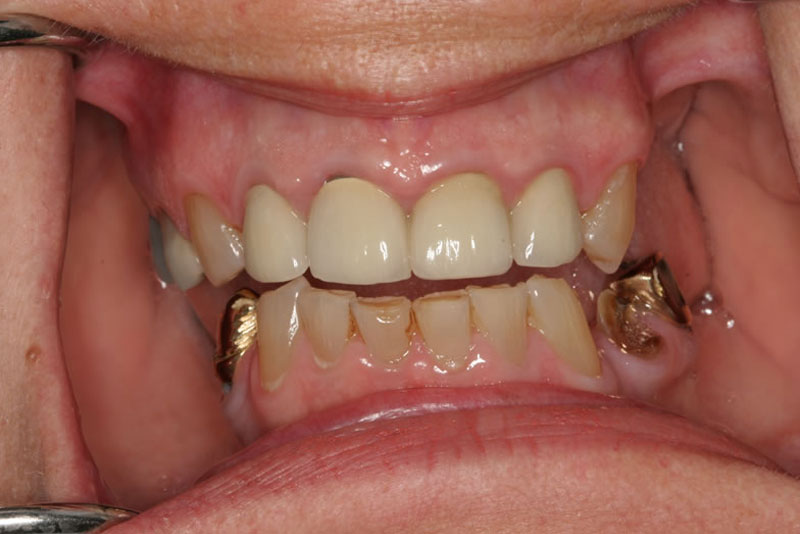 veneers case2 before