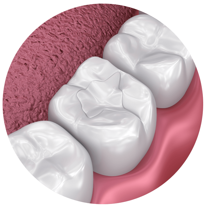 dental composite filling