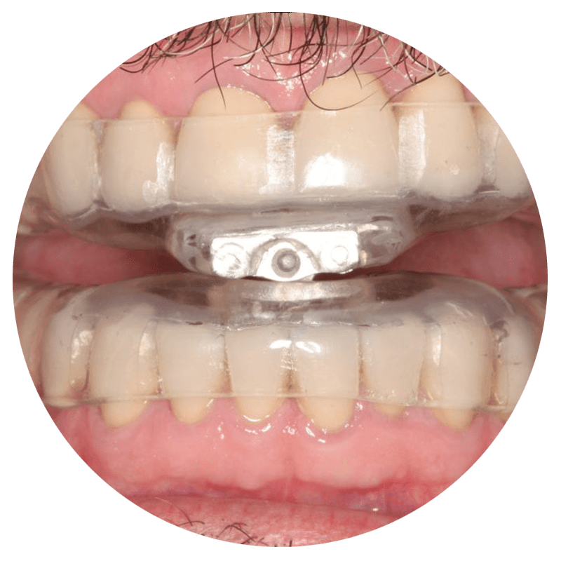 mouthguard for sleep apnea
