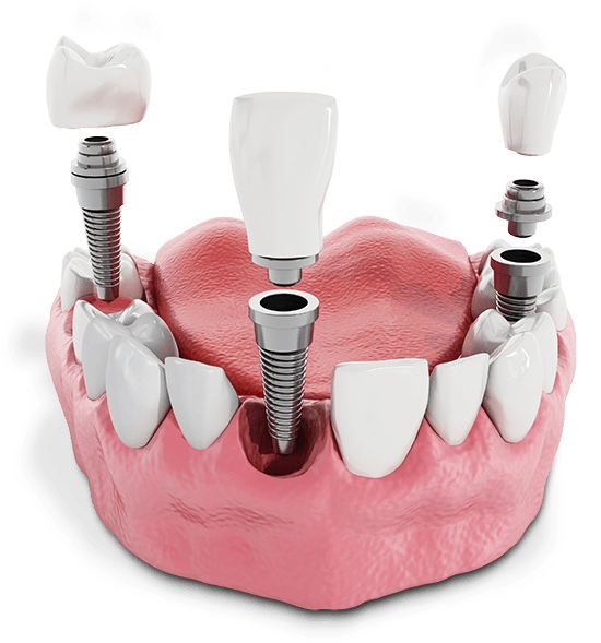 3D model of multiple dental implants in the upper jaw with crowns and abutments